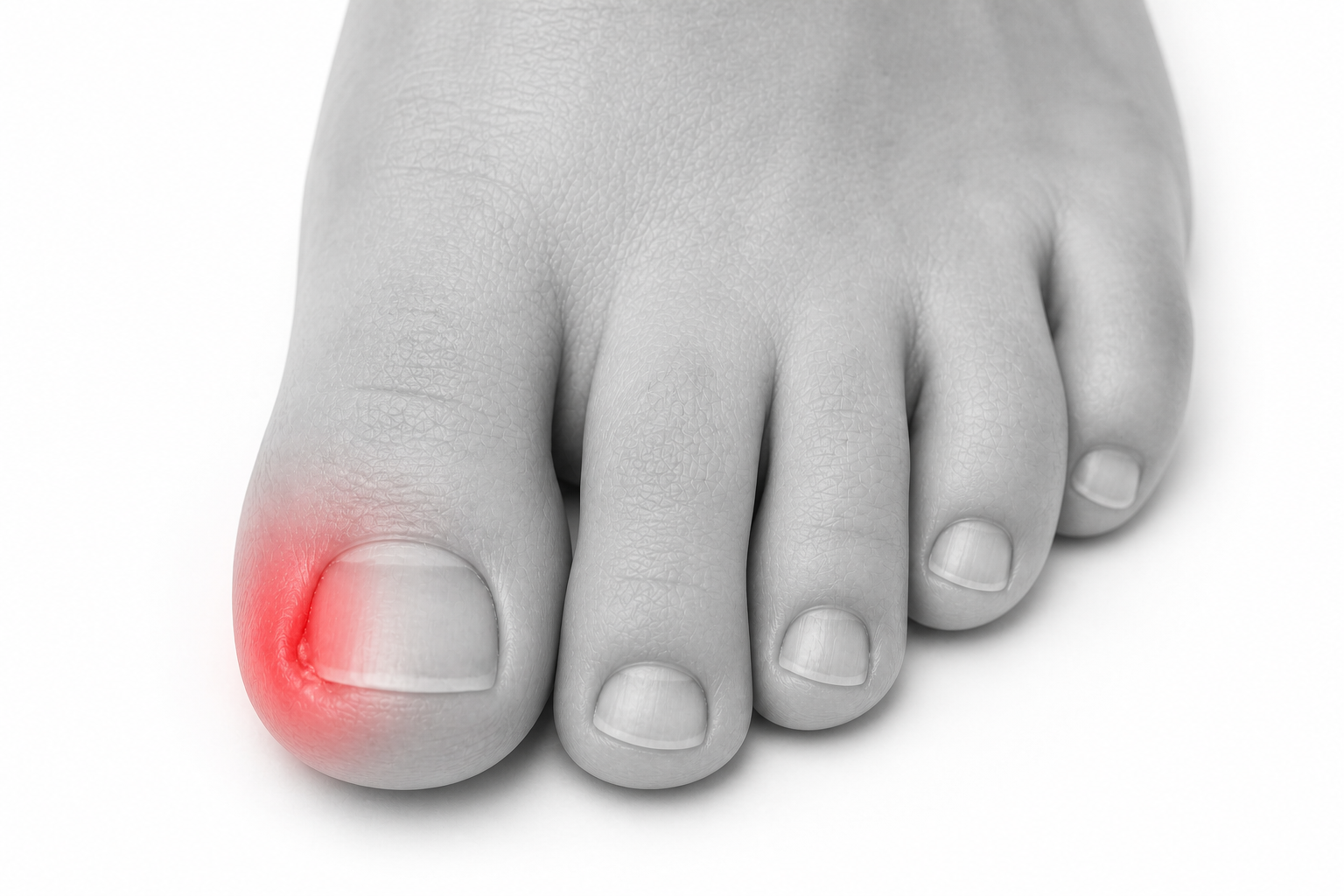 Illustration of Ingrown Toenails